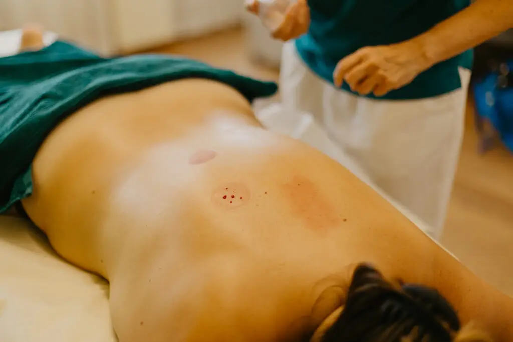 naturheiltherapie-schroepfen-frau